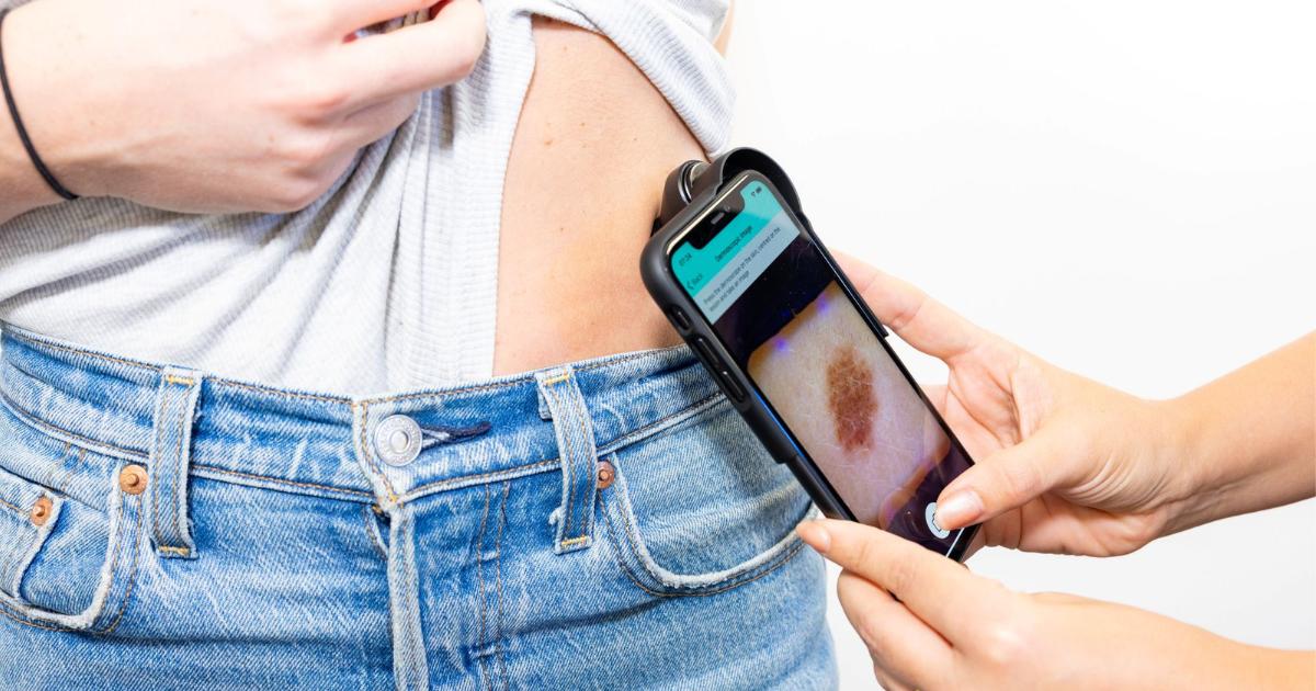 AI skin cancer triage to roll out across NHS South AI skin cancer triage to roll out across NHS South East